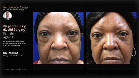 Laser Blepharoplasty Eyelid Surgery