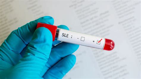 Saphnelo Side Effects - The Full List - MEDICA DEPOT