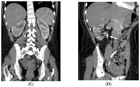 Complications Subsequent to Urinary Tract Stent Placement: An Overview ...