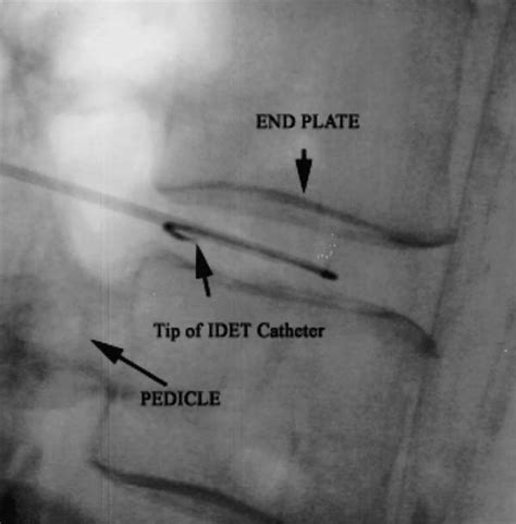 Image result for Idet Disc Procedure