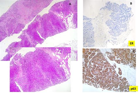 Primary metaplastic breast carcinoma or breast metastasis of a poorly ...