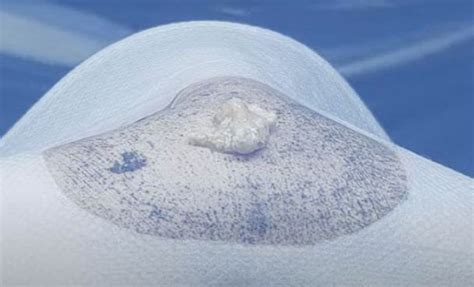 Largest Exploding Cyst 的图像结果