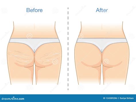 Before and after Reduction Stretch Marks Skin at Buttocks and Thighs. Stock Vector ...