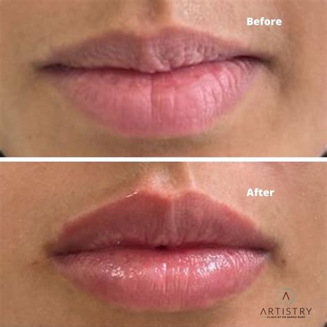 Lip Flip Botox - Everything You Need To Know
