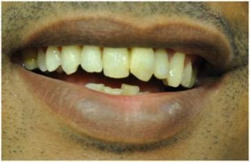 Splint Removal 的图像结果