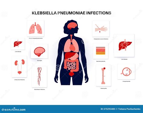 Klebsiella Pneumoniae Poster Cartoon Vector | CartoonDealer.com #375293485