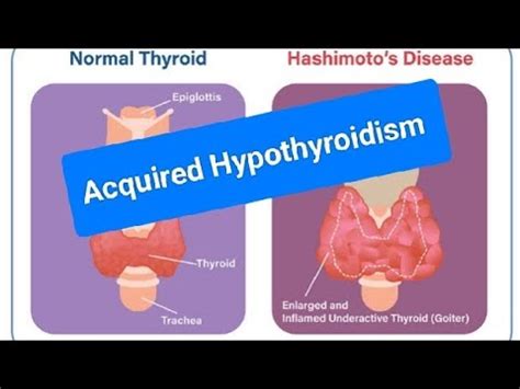 Image result for hyperthyroidism