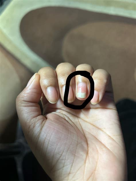 Why is my nail like this?! Is it Nail fungus ? Is my nail growing backwards?! Help : r/NailFungus
