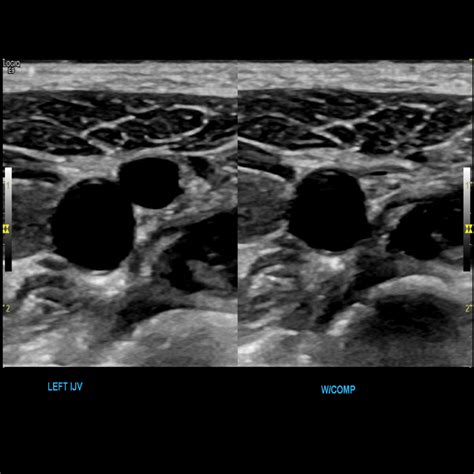 Upper Arm Vein Ultrasound at Tracey Parmelee blog