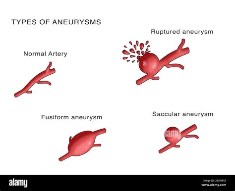 Fusiform aneurysms hi-res stock photography and images - Alamy