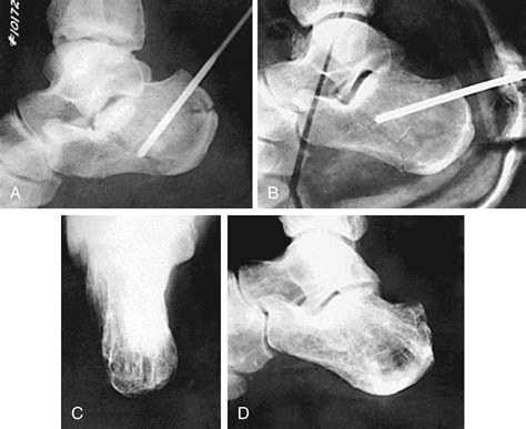 Fractures and Dislocations of the Foot - Clinical Tree