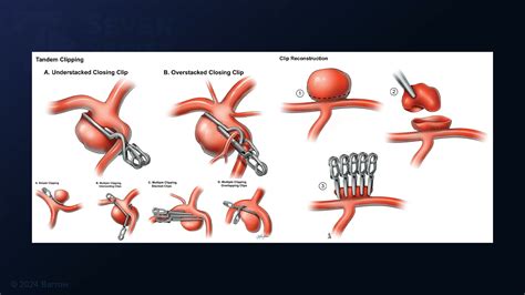 #343: Pterional Craniotomy for Clip Reconstruction of a Dolichoectatic ...