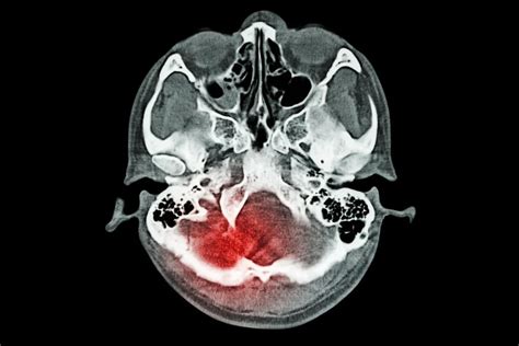 研究人员发现创伤性脑损伤与Long-COVID之间的联系 - 科技与健康 - cnBeta.COM