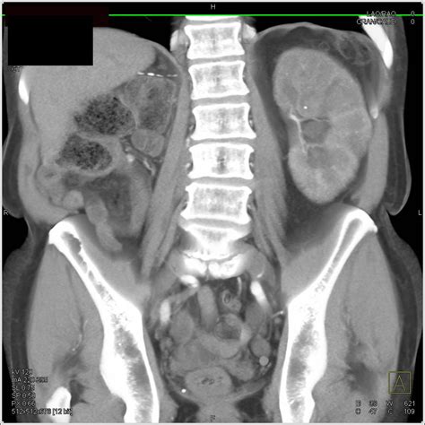 Multiple Renal Calculi in a Solitary Kidney - Kidney Radiology Case Studies - CTisus CT Scanning
