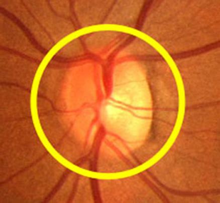 Image result for Ophthalmoscope Tutorial