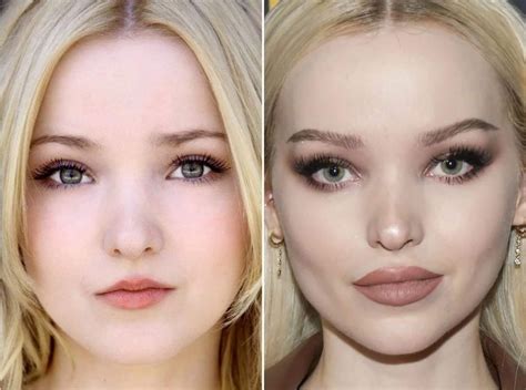 Dove Cameron Plastic Surgery: Before & After Photos | PlasticSurgeryInsights.com