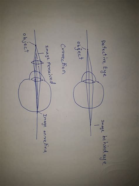 Name the defect of vision which can be corrected by a converging lens ...