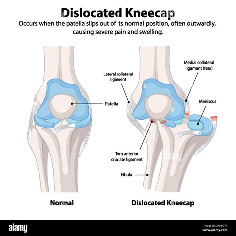Comparison of normal and dislocated kneecap Stock Vector Image & Art - Alamy