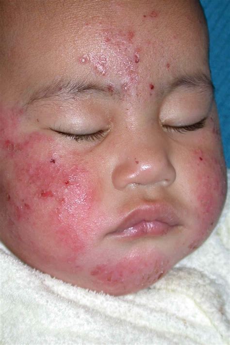 What's Behind Your Baby's Face Rash? Discover 10 Causes