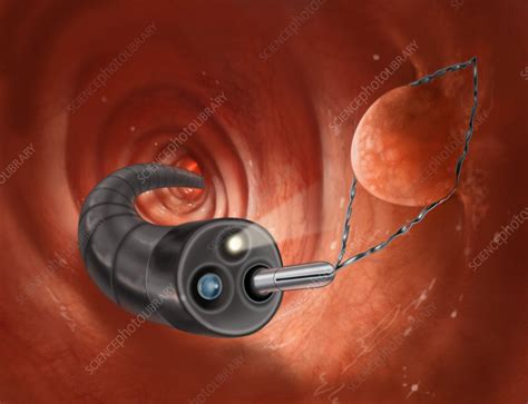 Image result for Colonoscopy Polypectomy