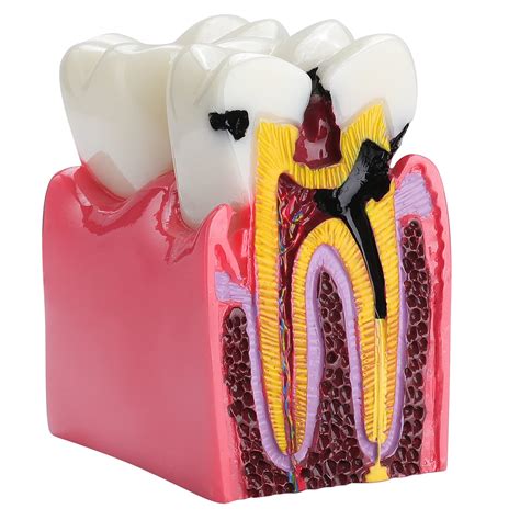 Buy Dental Caries Tooth Model - 6 Times Tooth Decay Model Dental Models ...