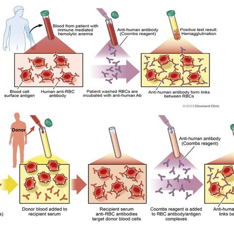Image result for Coombs Test Positive vs Negative