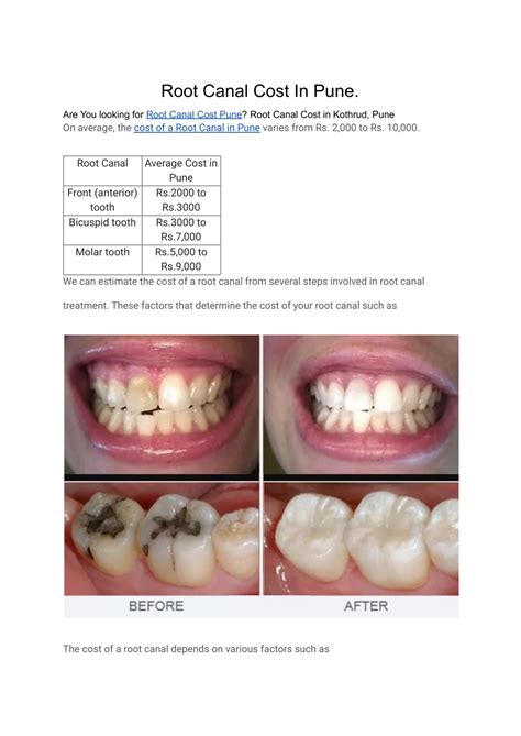 PPT - Root Canal Cost In Pune PowerPoint Presentation, free download - ID:11826419