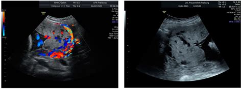 Placenta Accreta Spectrum (PAS): Diagnosis, Clinical Presentation, Therapeutic Approaches, and ...
