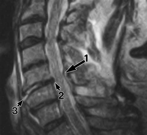 Anterior Longitudinal Ligament Mri Fractures And Dislocations Of The