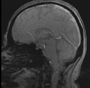 CSF Flow SCSN MRI 的图像结果