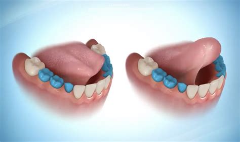 Patient's Guide to Tongue Ties | Jorgensen Orthodontics - Affordable Care