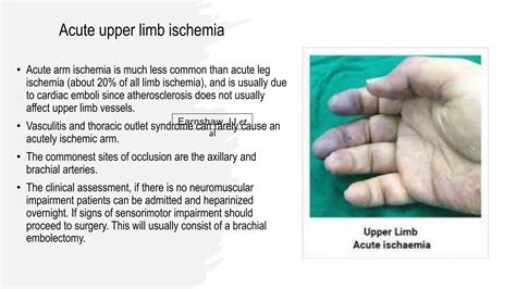 Acute Limb Ischemia | PPSX