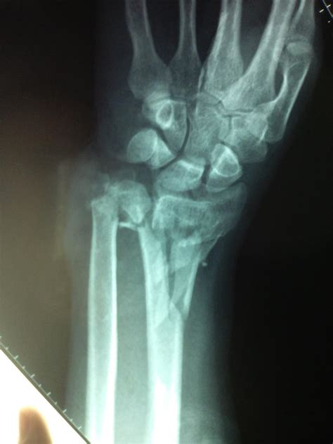 Distal Radius Fracture