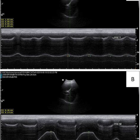 Image result for Excursion Lungs