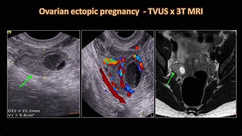 Ovarian Ectopic Pregnancy Ultrasound