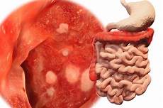 alimenti per colite ulcerosa colite ulcerosa e trapianto di microbiota anaerobico alimenti per colite ulcerosa colite ulcerosa e trapianto di microbiota anaerobico