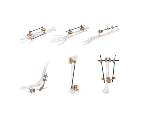 Image result for External Fixation Explained