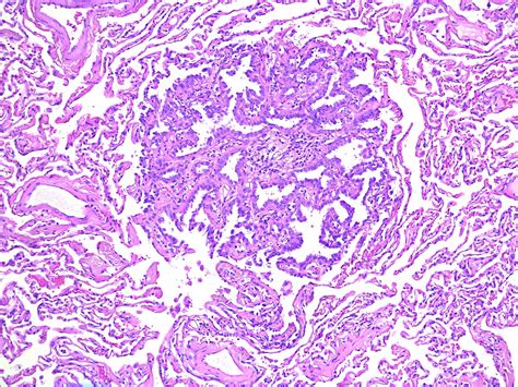 Atypical Adenomatous Hyperplasia