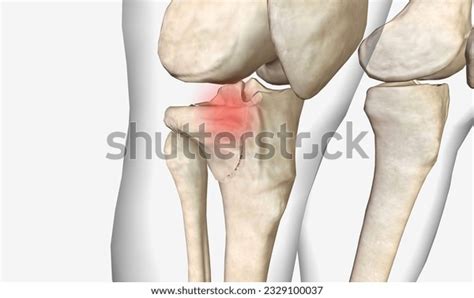 Proximal Tibia 的图像结果