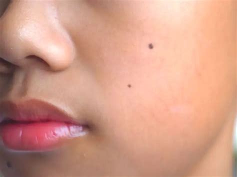 கன்னத்தில் மச்சம் (mole on cheek)