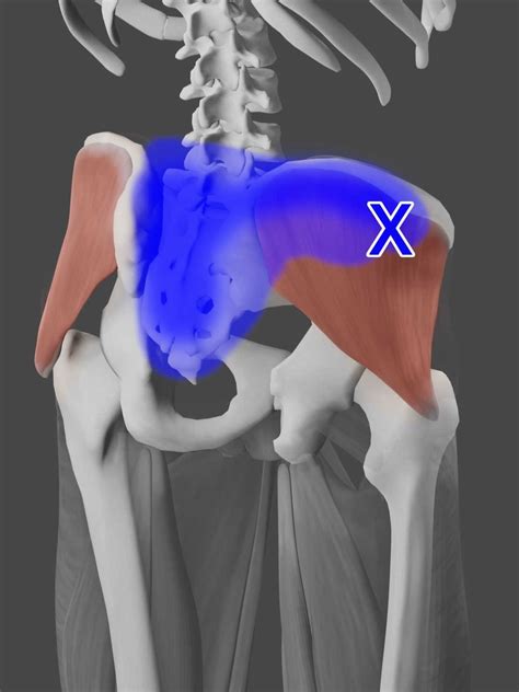 Gluteus Medius Pain