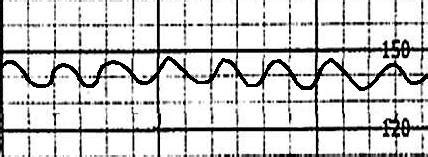 Intrapartum Fetal Heart Rate Monitoring — Perinatology.com
