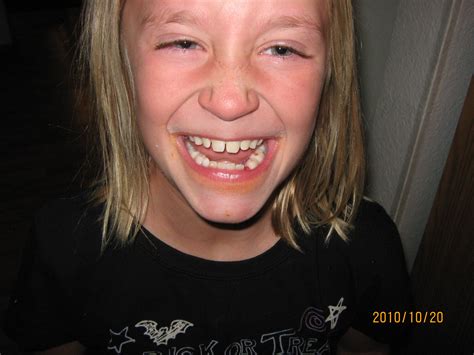 Image result for Lost Tooth