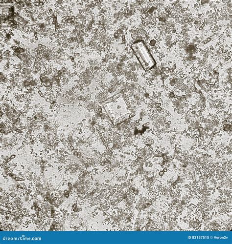 Crystals In Urine Amorphous Urates at James Loman blog