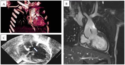 Double-Outlet Left Ventricle: Case Series and Systematic Review of the ...