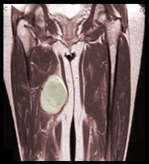 Sarcoma Images