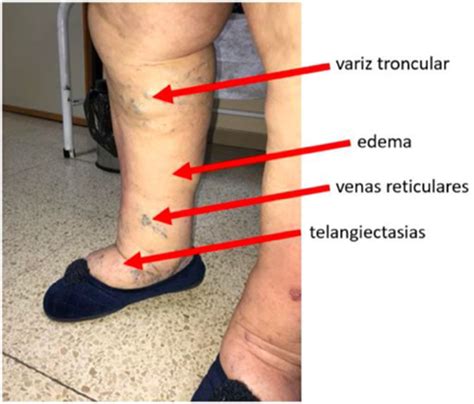 Estudio de la insuficiencia venosa crónica | Cirugía Cardiovascular