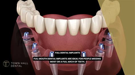 Full Dental Implants - Permanent Full Mouth Tooth Restoration