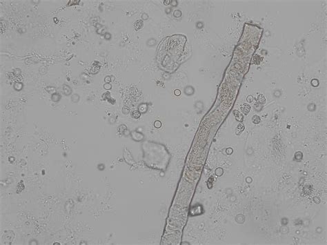 Waxy cast | CellWiki