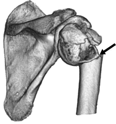 Classification Of Humeral Head Fracture Radiology at Paige Brown blog
